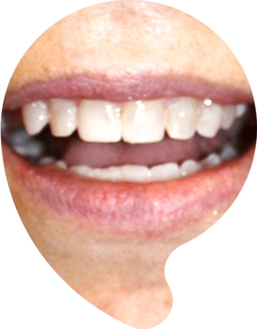 Same front tooth after composite bonding repair
