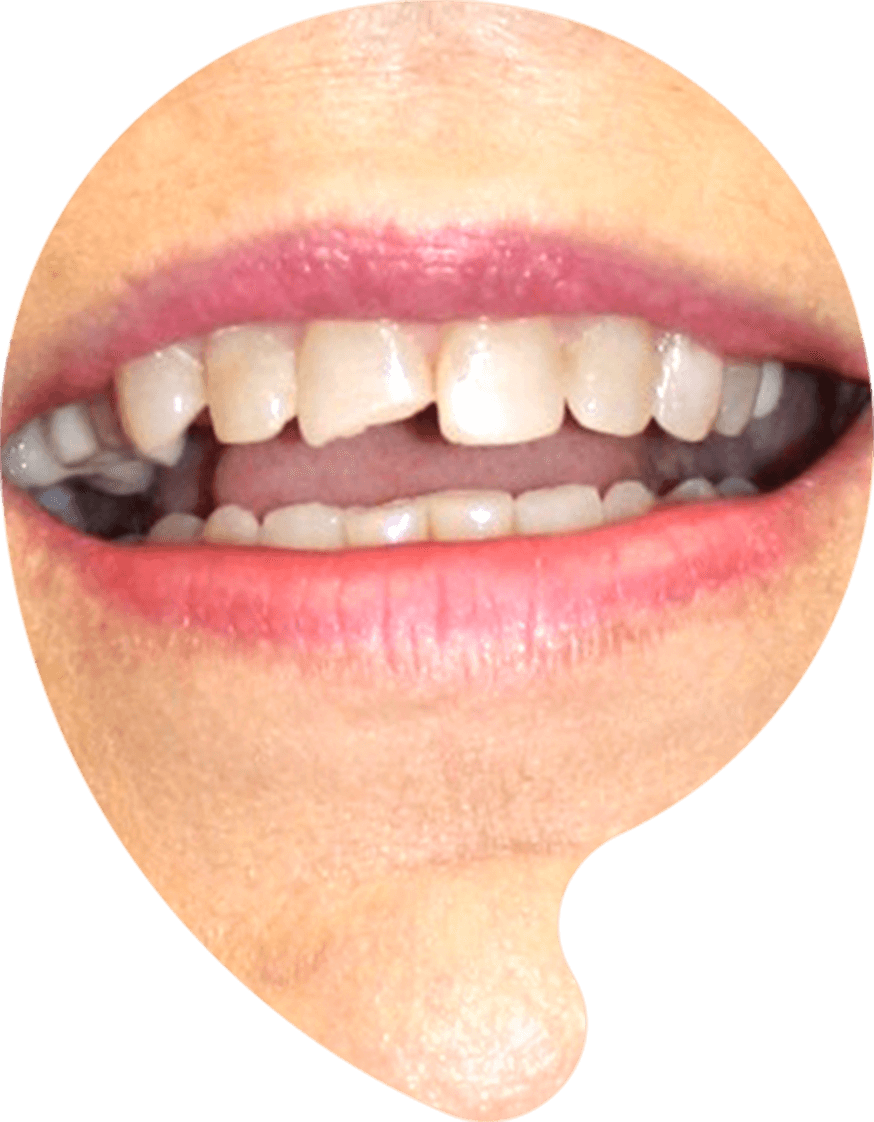 Chipped front tooth before bonding repair