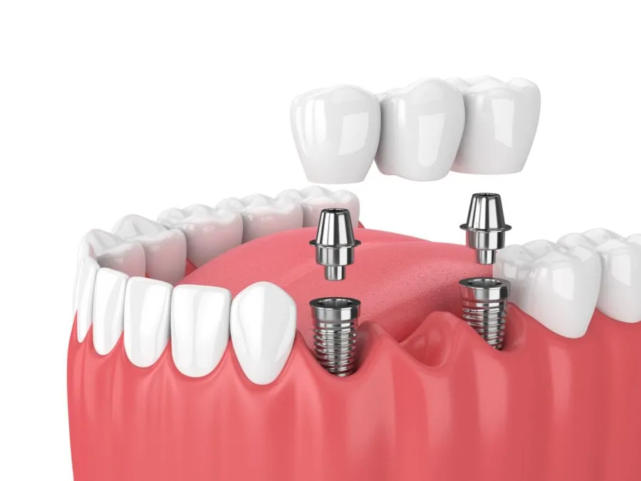 Same-day dental crown work at Absolute Quality Care Family Dentistry