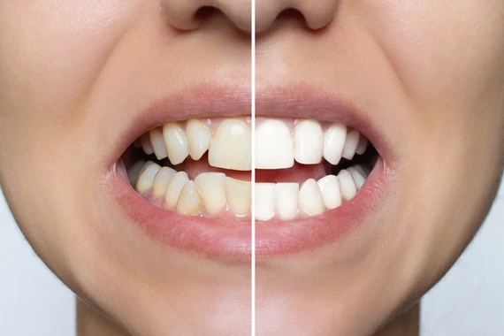 Before and after comparison of teeth showing veneer results: yellowed teeth on the left, bright white smile on the right
