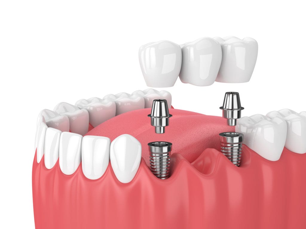implant-supported dental bridge treatment in Prairieville, Louisiana