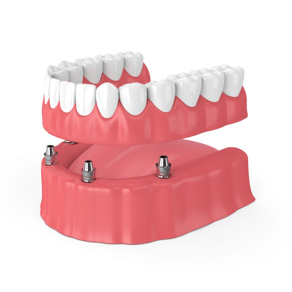 Implant-supported dentures in Prairieville, Louisiana